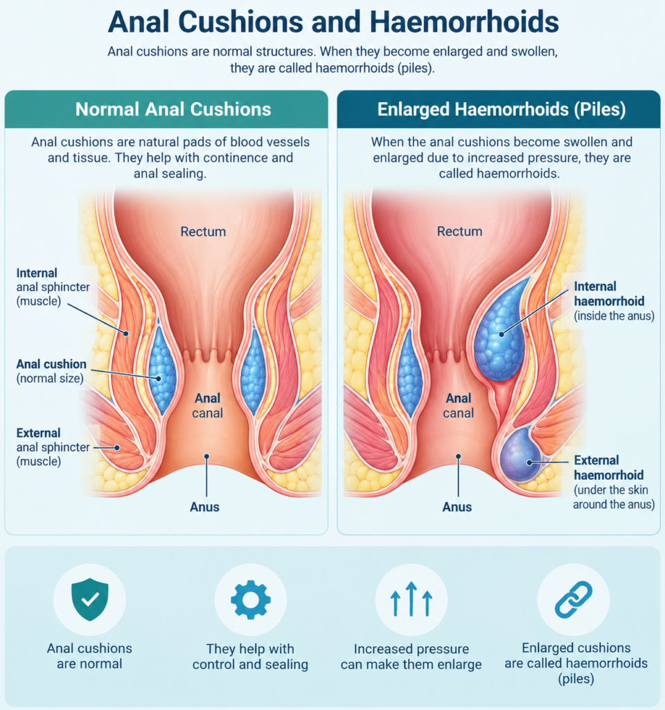 Medical diagram of anal cushions and haemorrhoids